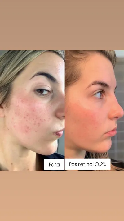 Serum për fytyrë kundër rrudhave The Ordinary Retinol 0.5% in Squalane, 30ml - 5
